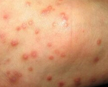 疥疮发病初期有哪些症状