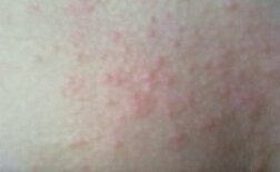 Ƥ������Ҫ��ô���ƺ�